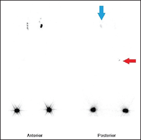 A 99m-Tc sulphur colloid lymphoscintigraphy of both lower limbs; anteriorly the dye has reached both the inguinal nodes freely; posteriorly the dye has reached the left deep inguinal lymph node (blue arrow) but has not completely reached the deep inguinal lymph node on the right; thus signifying a lymphatic obstruction at the right popliteal lymph node (red arrow).
